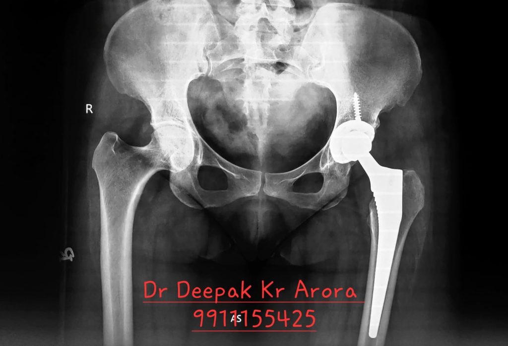 Image of a Hip after surgery performed by Dr Deepak Kr Arora at Esskay Ortho and Eye Center in Delhi.