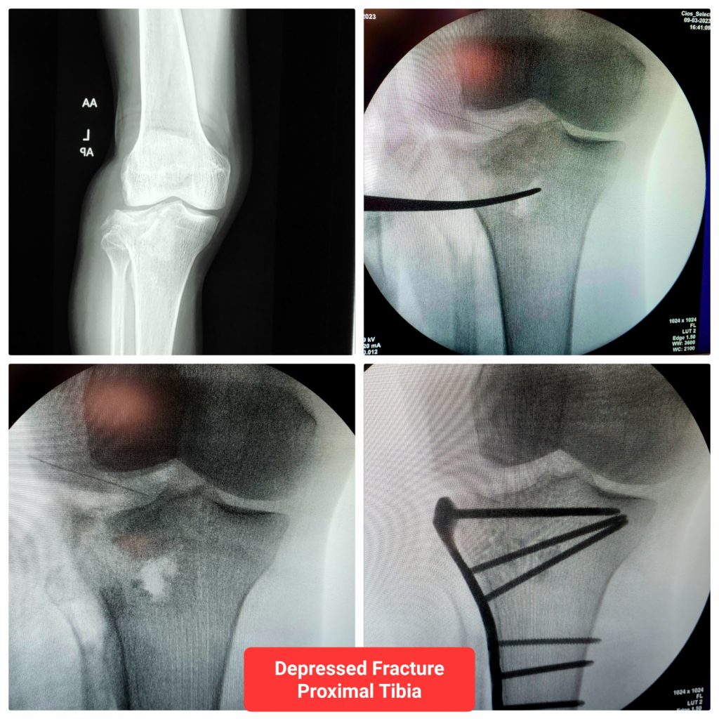 COMPLEX INTRA ARTICULAR FRACTURE MANAGEMENT surgery at Esskay Ortho & Eye Center Krishna Nagar in Delhi