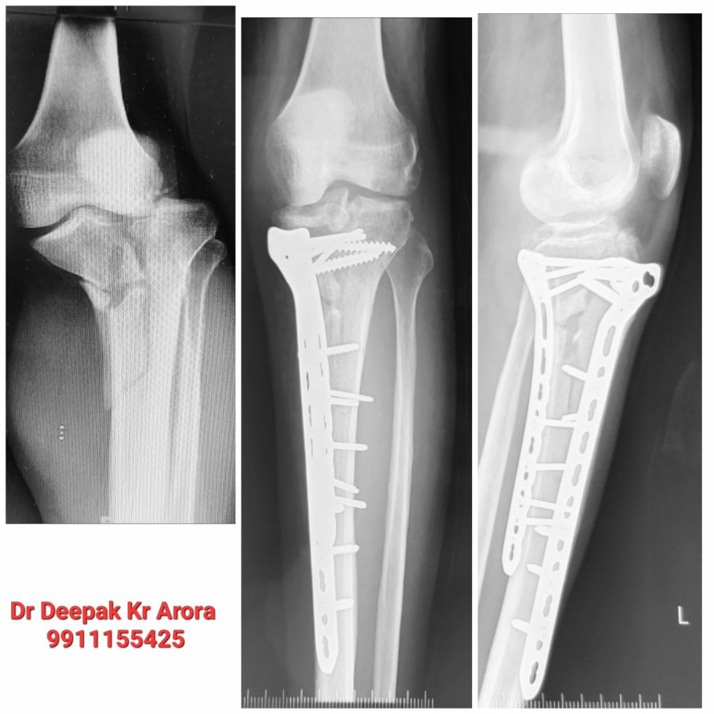 COMPLEX INTRA ARTICULAR FRACTURE MANAGEMENT surgery at Esskay Ortho & Eye Center Krishna Nagar in Delhi