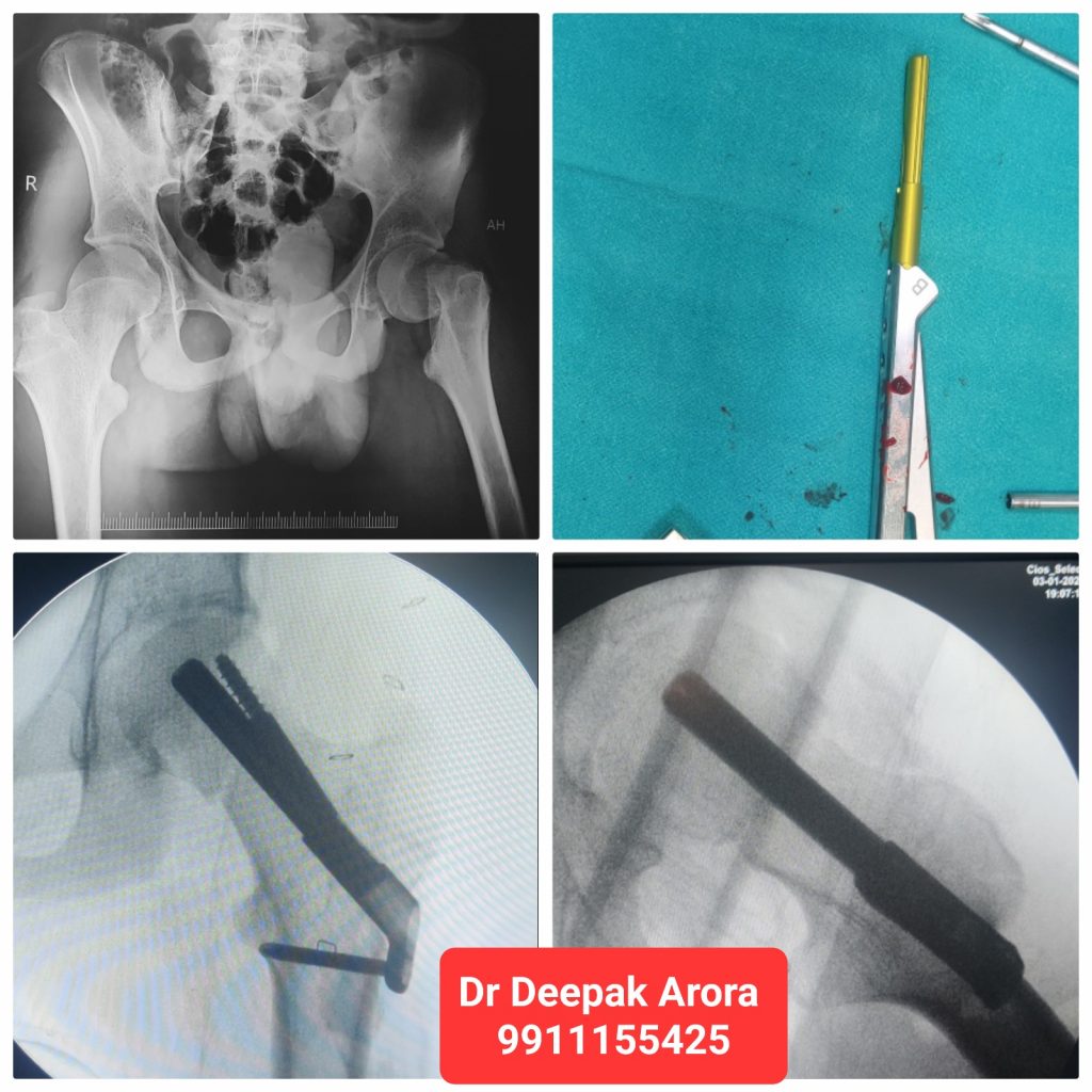 COMPLEX INTRA ARTICULAR FRACTURE MANAGEMENT surgery at Esskay Ortho & Eye Center Krishna Nagar in Delhi