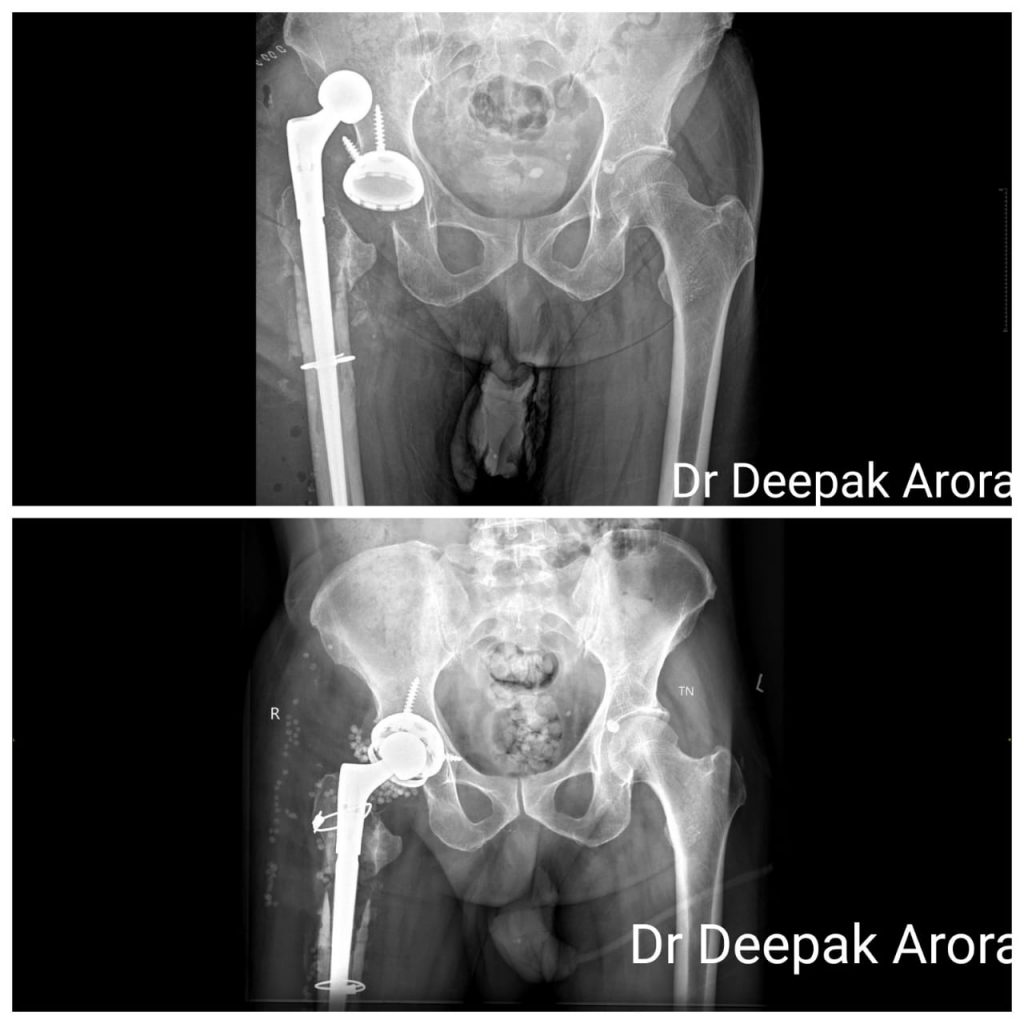 REVISION REPLACEMENT OF KNEE & HIP