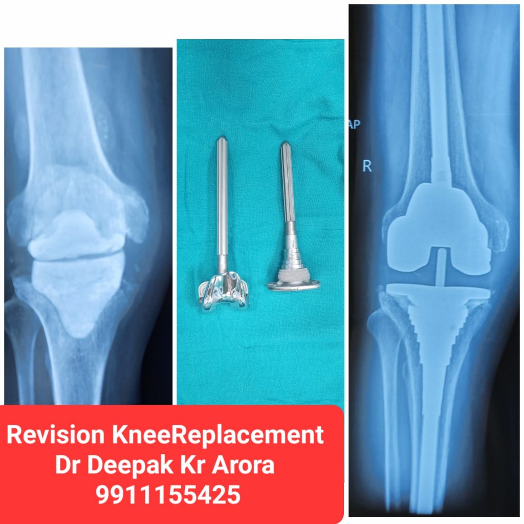 REVISION REPLACEMENT OF KNEE & HIP