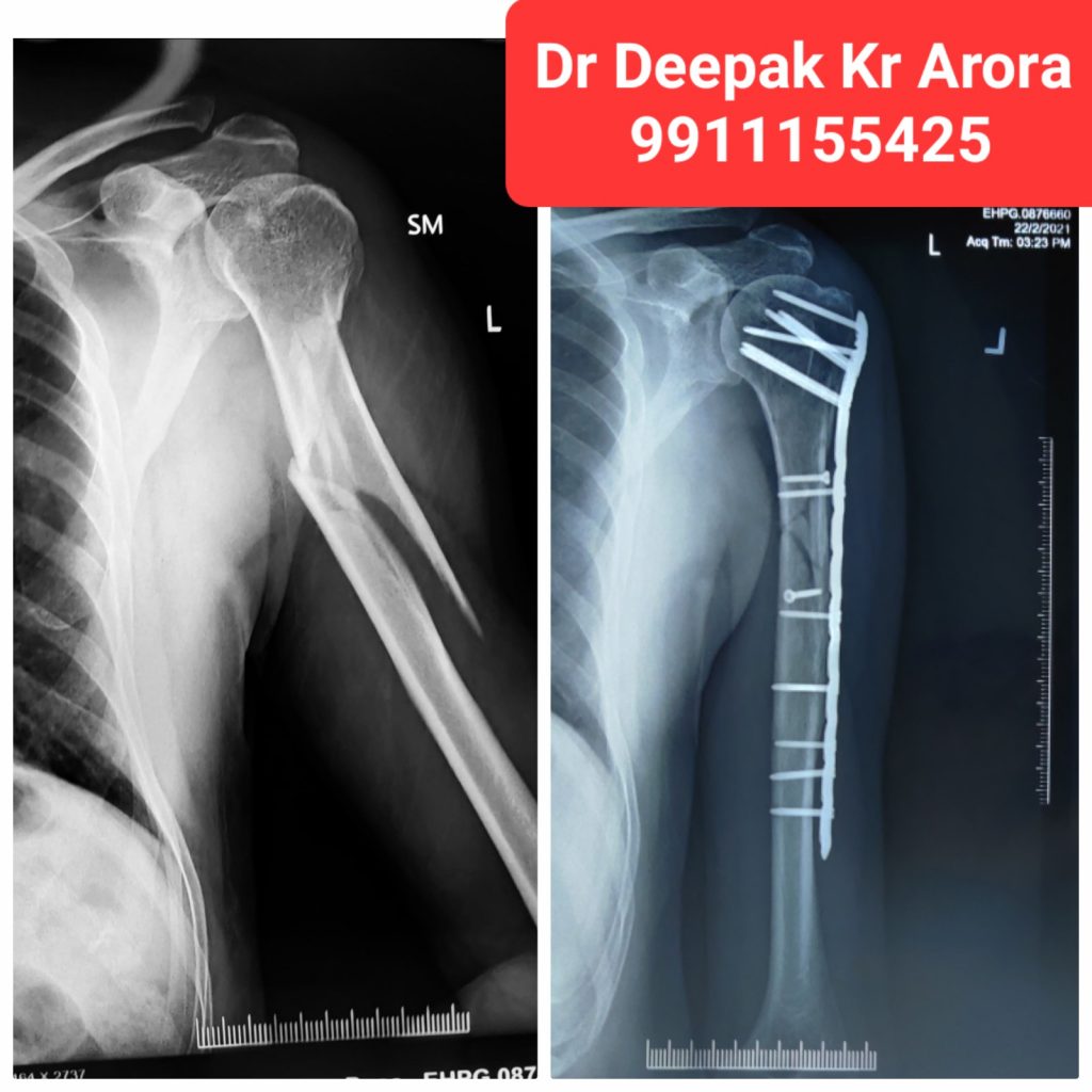 REVISION REPLACEMENT OF KNEE & HIP