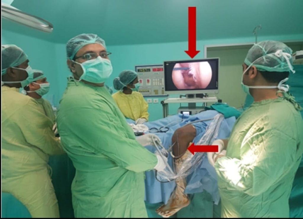 Doctors performing Arthroscopic Knee Surgery at Esskay Ortho & Eye Center Krishna Nagar, Delhi.