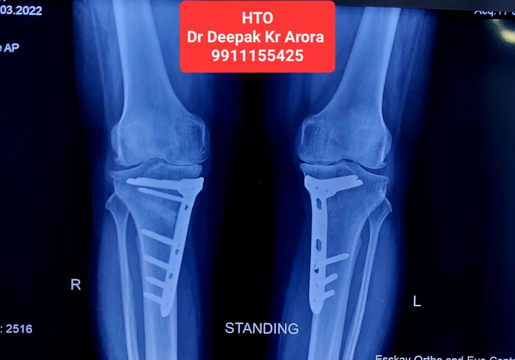 OSTEOPOROSIS TREATMENT surgery at Esskay Ortho & Eye Center Krishna Nagar in Delhi