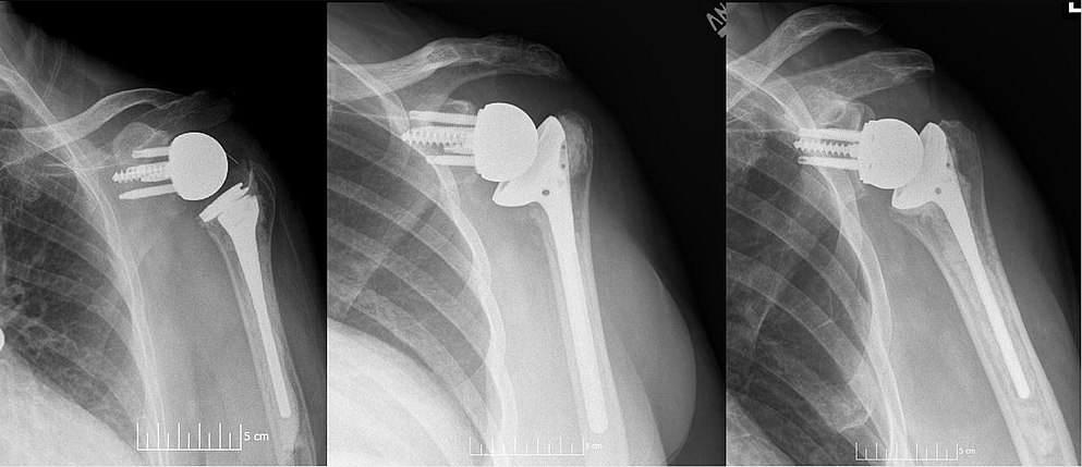 REVERSE SHOULDER REPLACEMENT