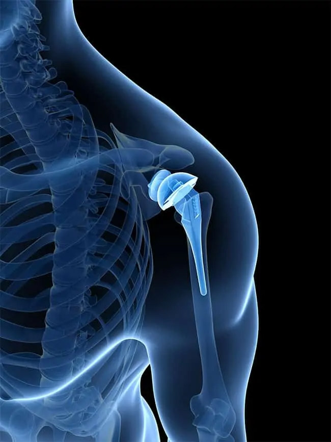 REVERSE SHOULDER REPLACEMENT